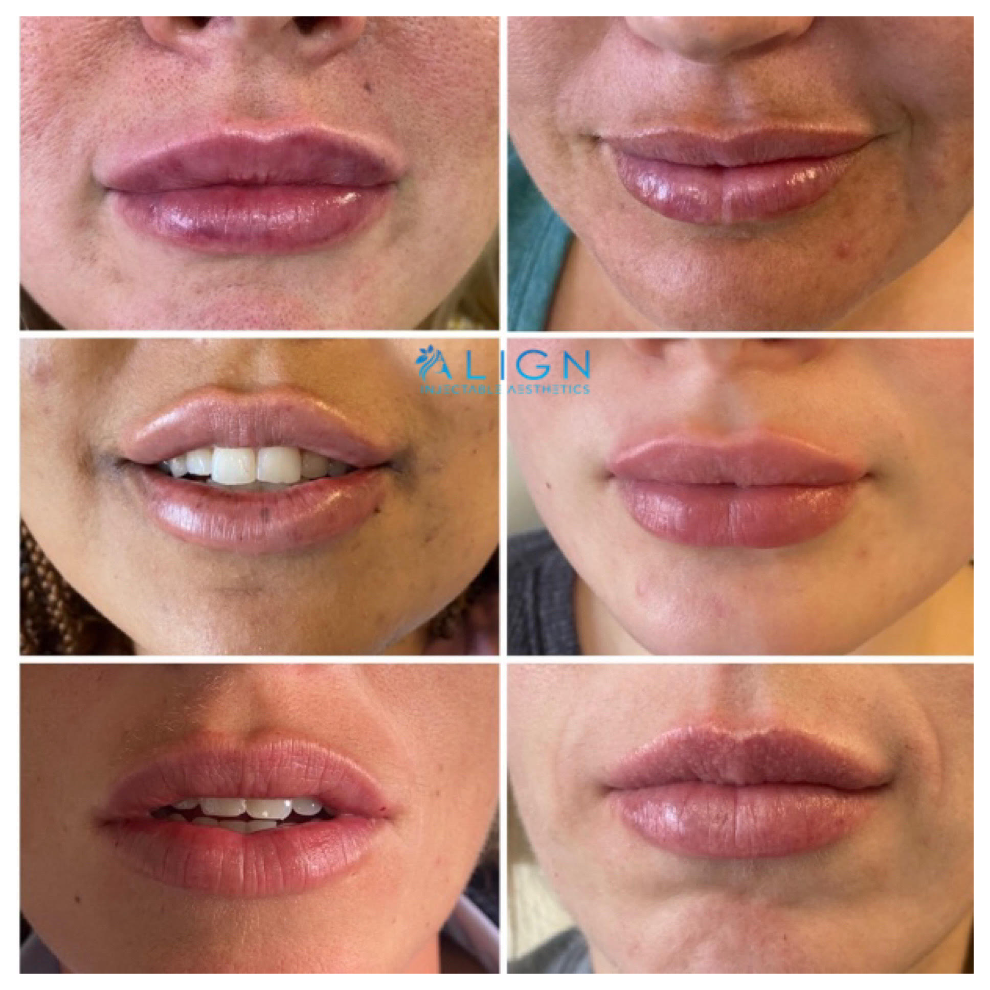 How Long Does Lip Injections Last? 
