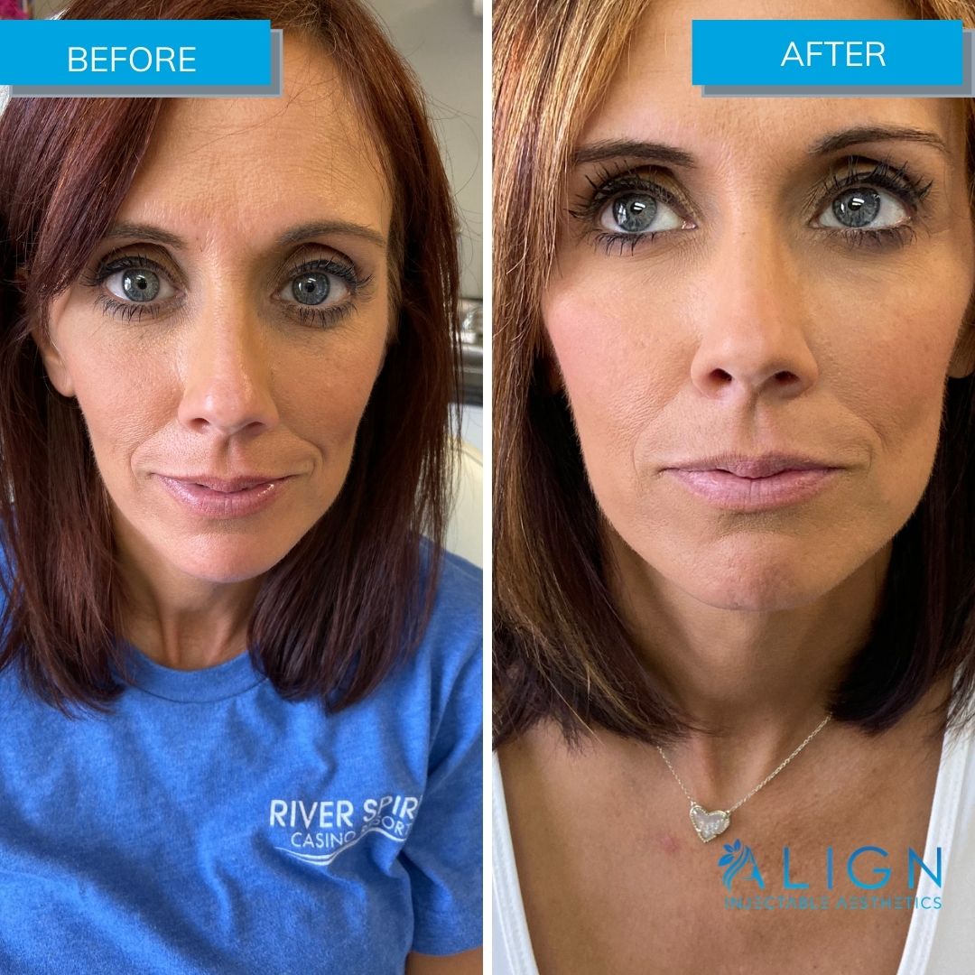 Before and After Cheek Filler at Align Injectable Aesthetics