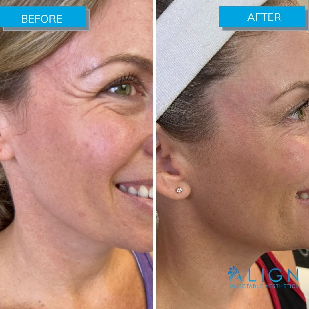 Before and After Botox® for Crow’s Feet