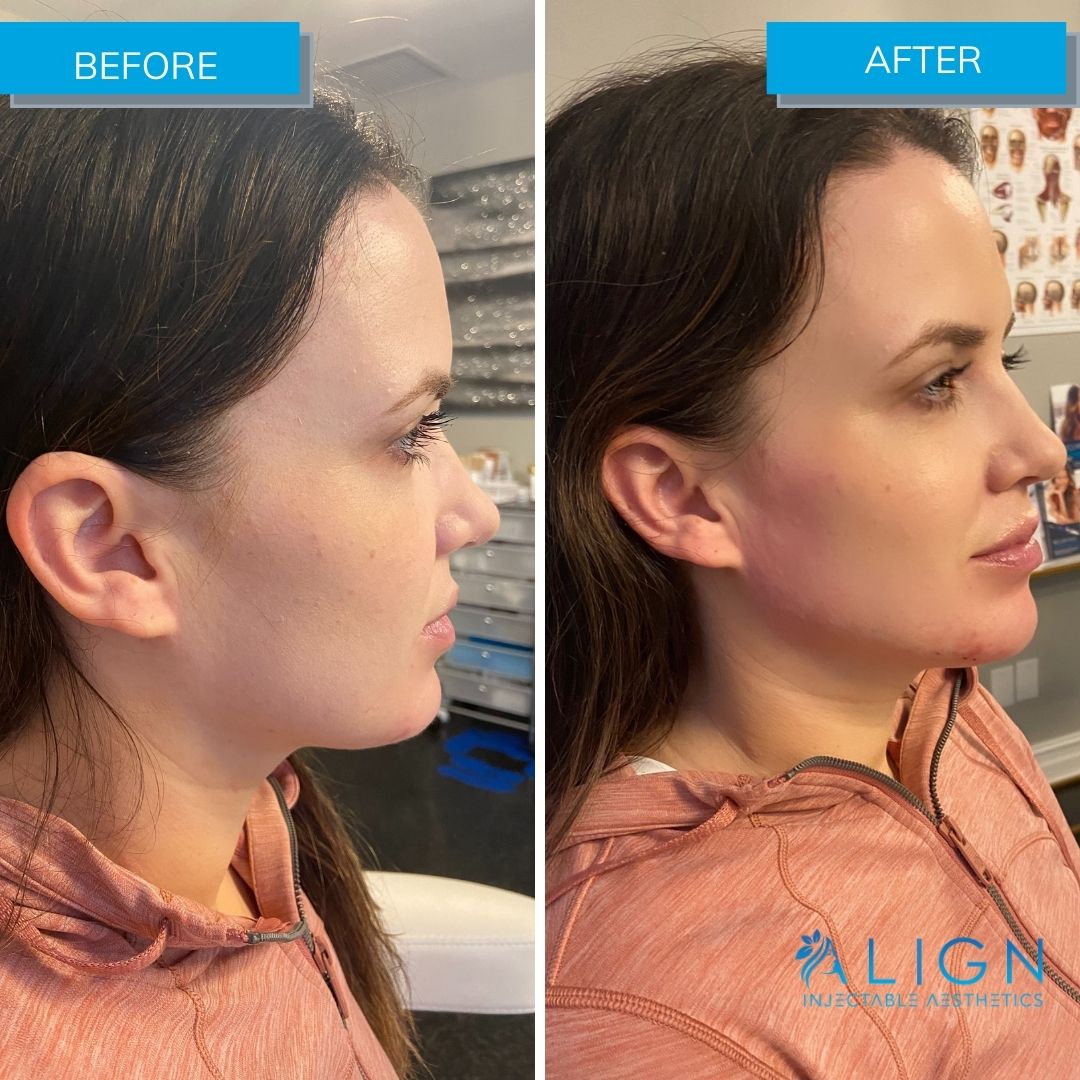 Before and After Jawline Filler