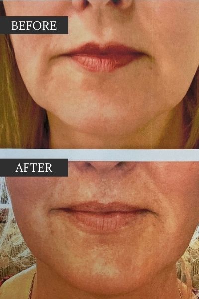 Agnes Results Before and After Jowl Removal