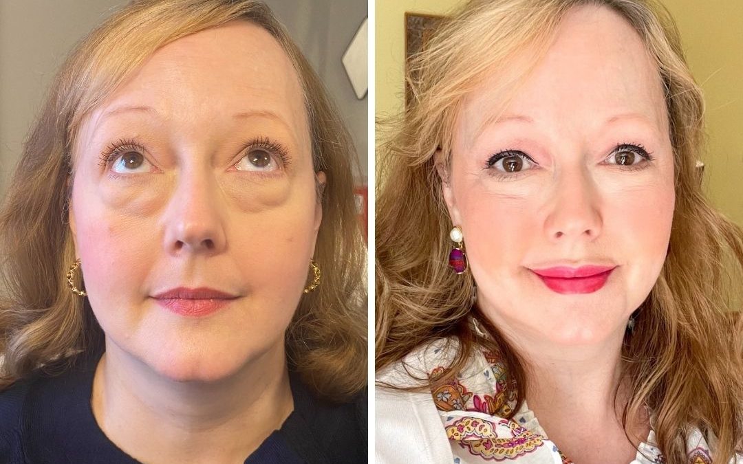 Agnes RF- Under Eye Bag Removal Archives | Align Injectable ...